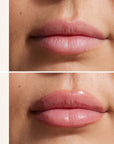 Lip Filler 001