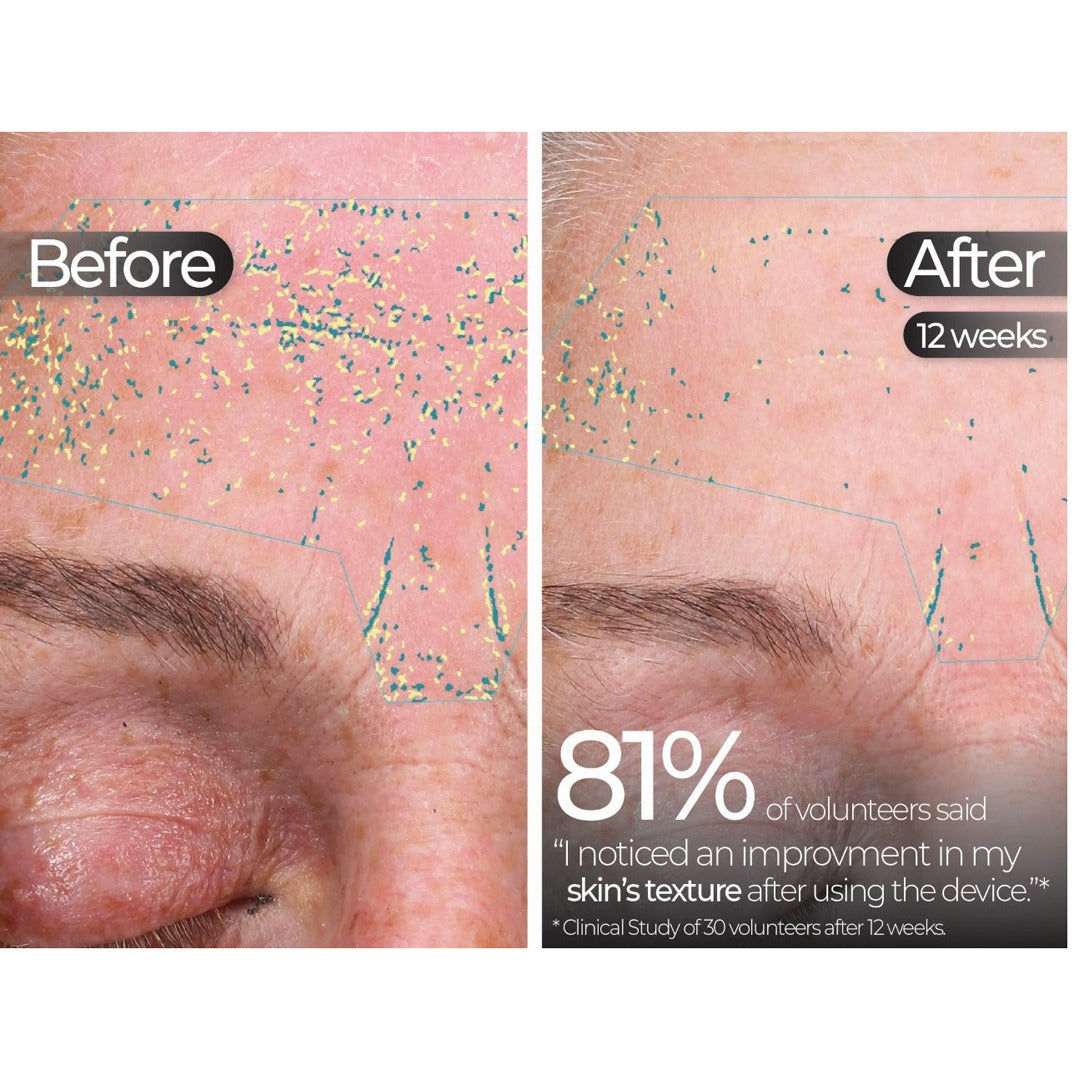 Wavelength Pro 5-in-1 LED Mask